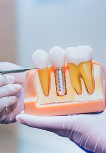 Dentist pointing to a dental implant model