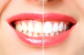 Before and after picture of teeth whitening in Plymouth